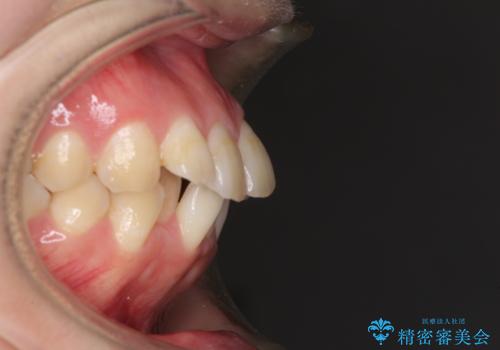前歯の出っ歯と口の閉じにくさを抜歯矯正で改善 目立たないワイヤー矯正の治療前
