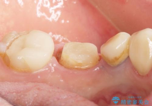 古い被せ物をセラミックにしたい 40代男性の治療中