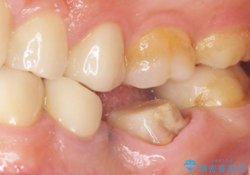 古い被せ物をセラミックにしたい 40代男性の治療中