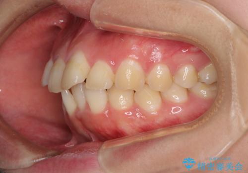 前歯の出っ歯と口の閉じにくさを抜歯矯正で改善 目立たないワイヤー矯正の治療前