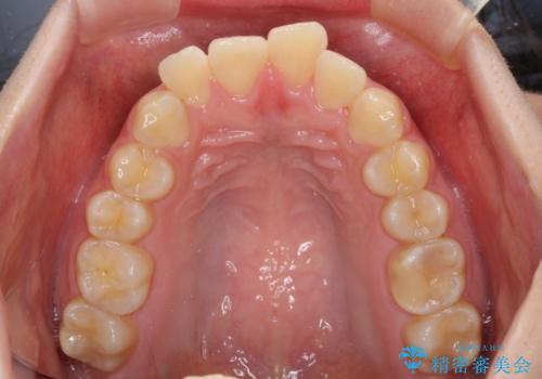 前歯の出っ歯と口の閉じにくさを抜歯矯正で改善 目立たないワイヤー矯正の治療前