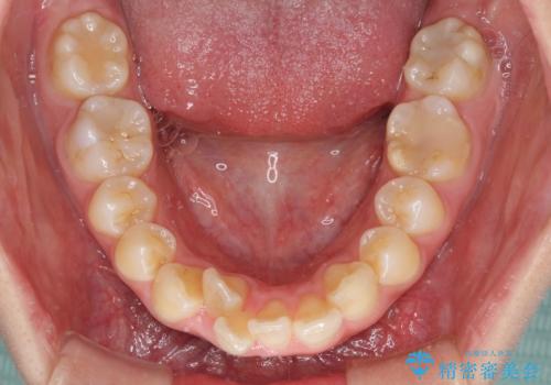 前歯の出っ歯と口の閉じにくさを抜歯矯正で改善 目立たないワイヤー矯正の治療前