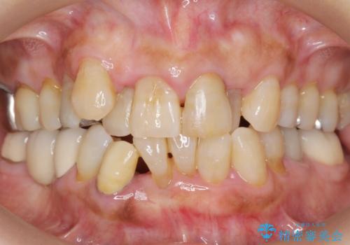 親知らずの移植 4年半経過症例 70代女性の治療後