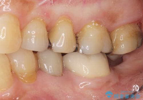 親知らずの移植 4年半経過症例 70代女性の症例 治療後