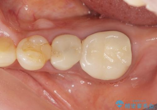 親知らずの移植 4年半経過症例 70代女性の治療後