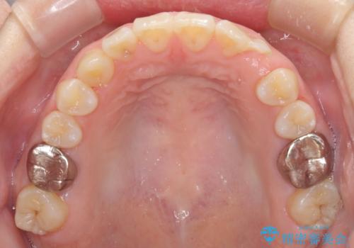 受け口で開咬を急速拡大装置とインビザラインで改善　欠損部分はインプラントにて補綴治療の治療中