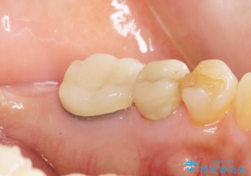 親知らずの移植 4年半経過症例 70代女性の治療後