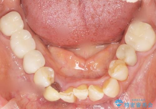 親知らずの移植 4年半経過症例 70代女性の治療後
