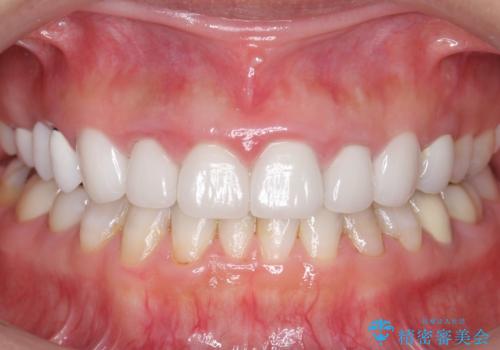 かぶせものと歯ぐきの境目が黒い 40代女性の治療前