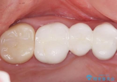 かぶせものと歯ぐきの境目が黒い 40代女性の治療前