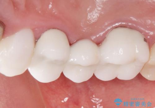 かぶせものと歯ぐきの境目が黒い 40代女性の治療前