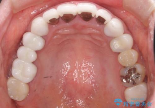 かぶせものと歯ぐきの境目が黒い 40代女性の治療前