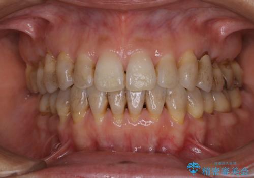 PMTCをして1日で真っ白なピカピカな歯に!の症例 治療前