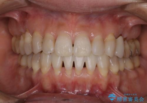 PMTCをして1日で真っ白なピカピカな歯に!の症例 治療後