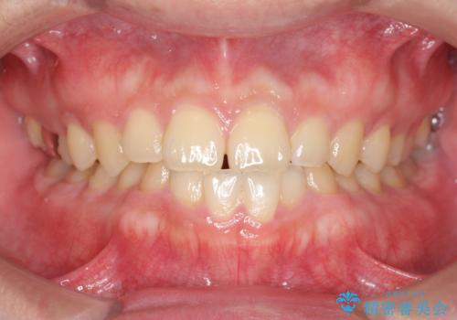 インビザラインで行うカモフラージュ矯正の症例 治療前