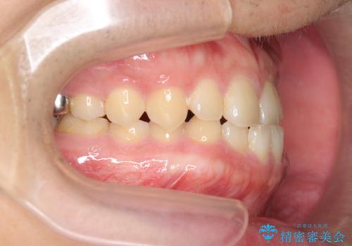 インビザラインで行うカモフラージュ矯正の治療前