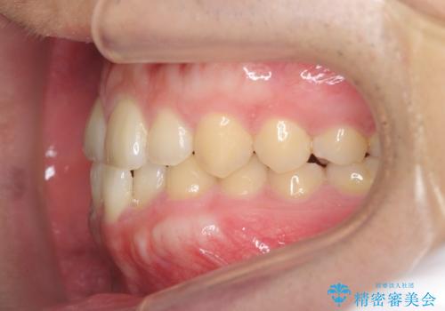 インビザラインで行うカモフラージュ矯正の治療前
