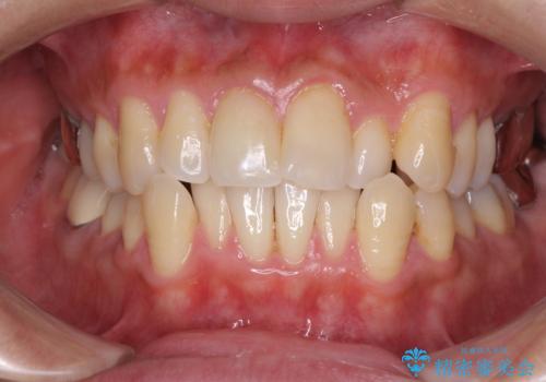 受け口傾向の咬み合わせ　前歯のデコボコをワイヤー矯正で素早く改善の症例 治療前