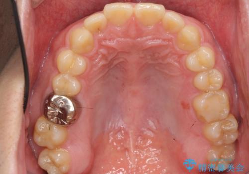 インビザラインで行うカモフラージュ矯正の治療前