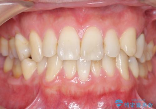 内側に生えている歯をなんとかしたい 矯正は嫌 30代男性の治療前