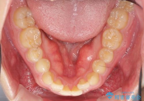 インビザラインで行うカモフラージュ矯正の治療前