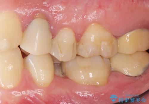 内側に生えている歯をなんとかしたい 矯正は嫌 30代男性の治療前