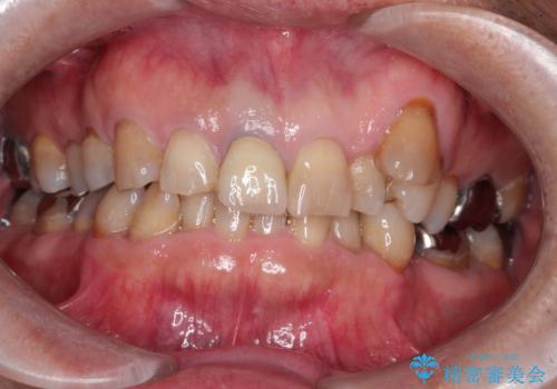 セラミックによる前歯の変色の改善の症例 治療後