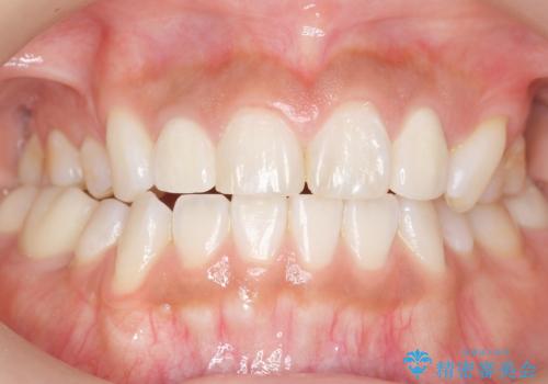 前歯の色と隙間が気になる　早く治したい　矯正は嫌　30代女性の治療後