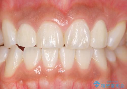 前歯の色と隙間が気になる 早く治したい 矯正は嫌 30代女性の症例 治療後