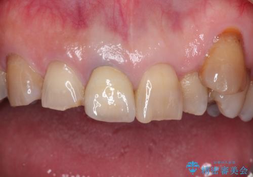 セラミックによる前歯の変色の改善の治療後