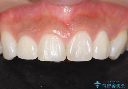 前歯の色と隙間が気になる 早く治したい 矯正は嫌 30代女性の治療後