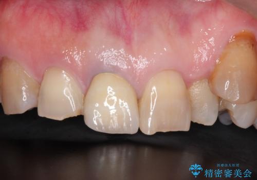 セラミックによる前歯の変色の改善の治療後