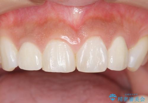 前歯の色と隙間が気になる 早く治したい 矯正は嫌 30代女性の治療後