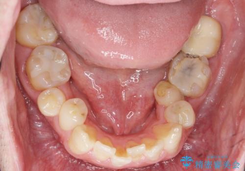 内側に生えている歯をなんとかしたい　矯正は嫌　30代男性の治療前