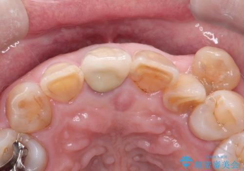 セラミックによる前歯の変色の改善の治療後