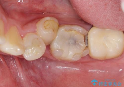 内側に生えている歯をなんとかしたい　矯正は嫌　30代男性の治療前