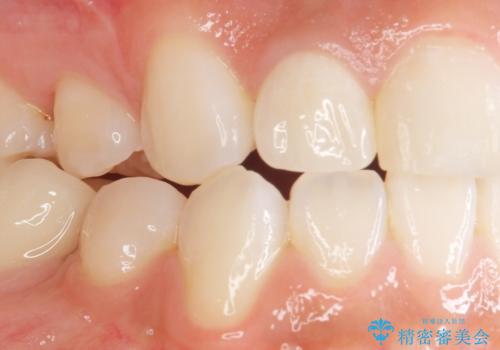 前歯の色と隙間が気になる 早く治したい 矯正は嫌 30代女性の治療後