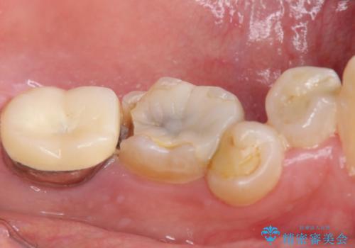 内側に生えている歯をなんとかしたい 矯正は嫌 30代男性