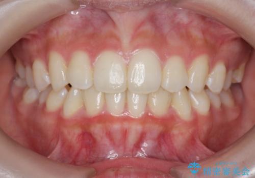 [ インビザラインライト ]   短期間で前歯だけを並べたいの治療後