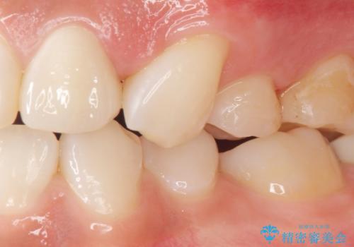 前歯の色と隙間が気になる 早く治したい 矯正は嫌 30代女性の治療後