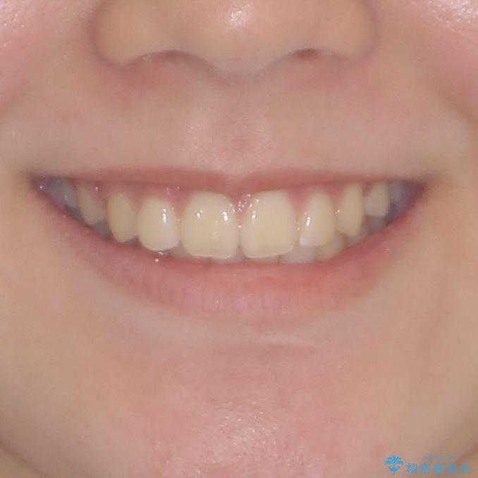 下の前歯が隠れてしまうほど深い咬み合わせ 高校生のインビザライン矯正治療の治療後(顔貌)