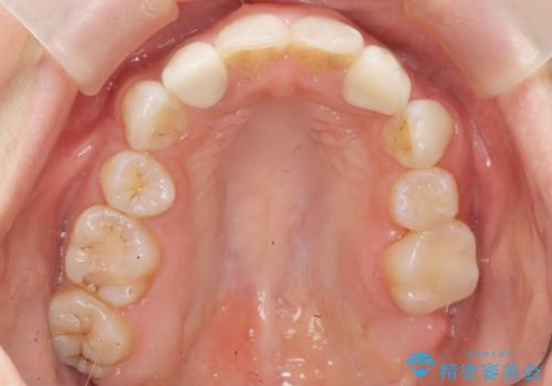 前歯の色と隙間が気になる 早く治したい 矯正は嫌 30代女性の治療後