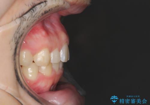 出っ歯が気になる インビザラインによる出っ歯の目立たない矯正の治療後
