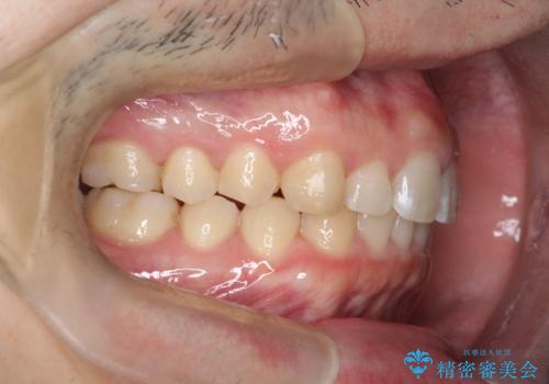 出っ歯が気になる　インビザラインによる出っ歯の目立たない矯正の治療後