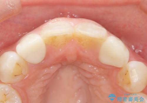前歯の色と隙間が気になる 早く治したい 矯正は嫌 30代女性の治療後