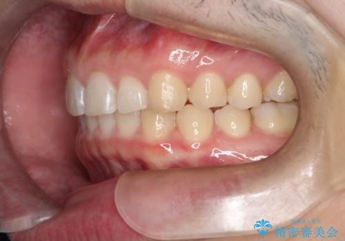 出っ歯が気になる　インビザラインによる出っ歯の目立たない矯正の治療後