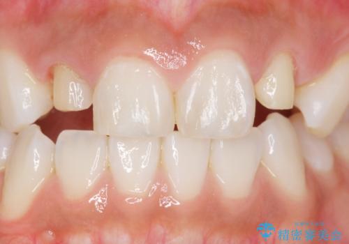 前歯の色と隙間が気になる 早く治したい 矯正は嫌 30代女性の治療中