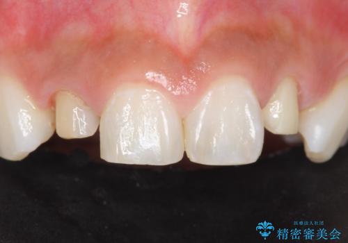 前歯の色と隙間が気になる 早く治したい 矯正は嫌 30代女性の治療中