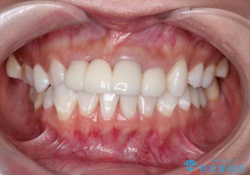 オフィスホワイトニング スペシャルコースの治療前