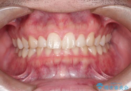 出っ歯が気になる　インビザラインによる出っ歯の目立たない矯正の治療前
